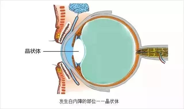 白内障最新疗法白内障最新疗法，引领视界新篇章